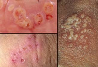 Genital herpes ve oral herpes nedir?