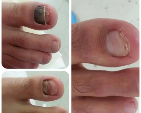 İleri düzey tırnak mantarı nasıl tedavi edilir – etkili yöntemler