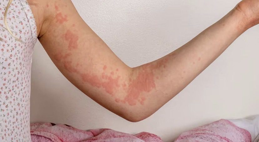 Besin alerjileri artıyor mu? Süt ve bazı gıdalara karşı reaksiyonlar neden daha sık görülüyor?