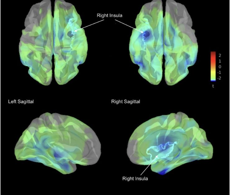 Beynin derininde saklı harita ortaya çıktı: Epilepsi ameliyatlarında riskler azalabilir mi?