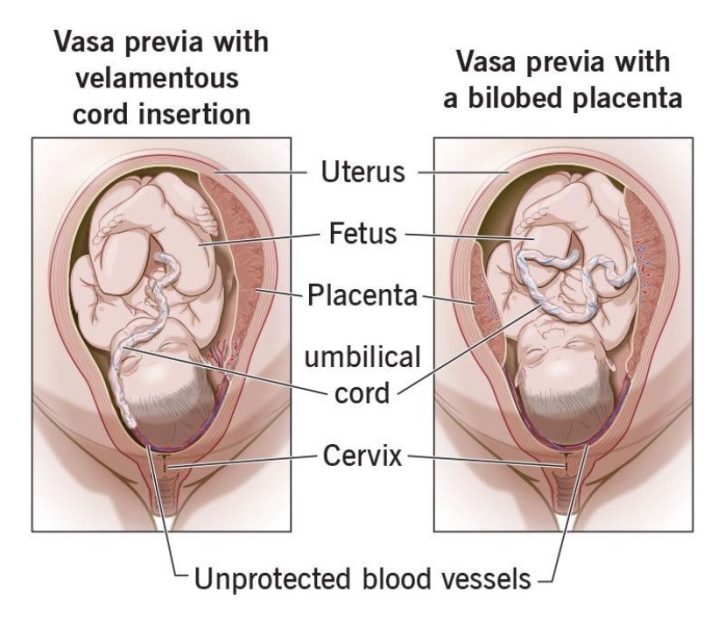Vasa previa nedir?